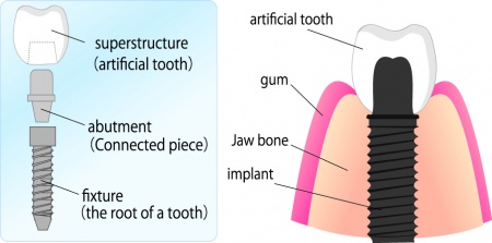 dental implants Edinburgh