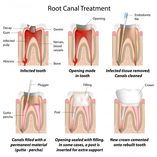 root canal treatment Edinburgh dentists