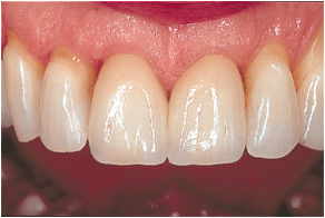 Dental crowns after