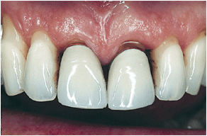Dental crowns before
