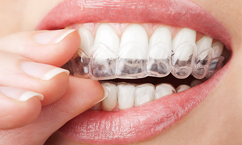 teeth whitening Edinburgh dentists