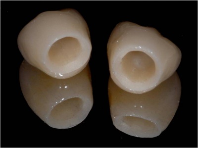 All ceramic crowns Corstorphine Dental Centre